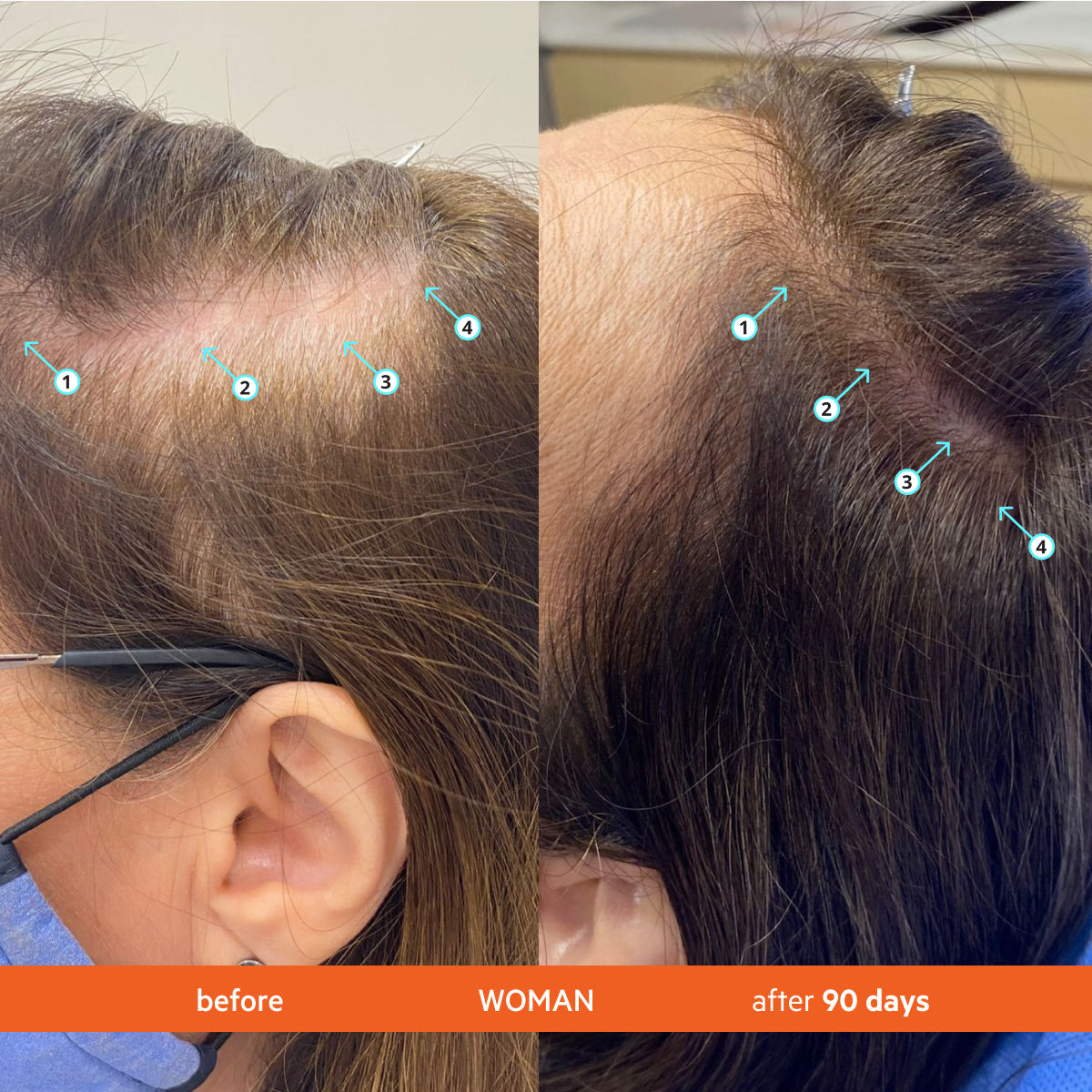 Revita Kit | High-Performance Hair Density Shampoo & Conditioner